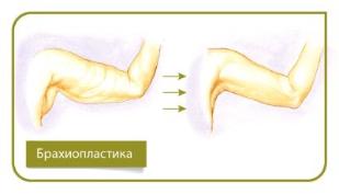 Брахиопластика (пластика кожи рук)