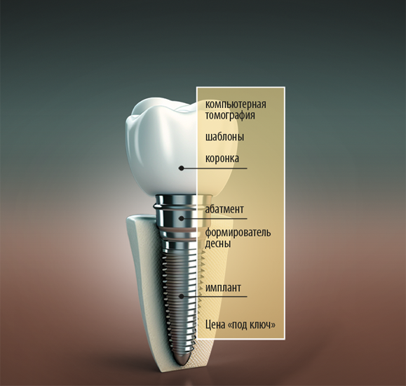 "Готовый зуб" на импланте под ключ
