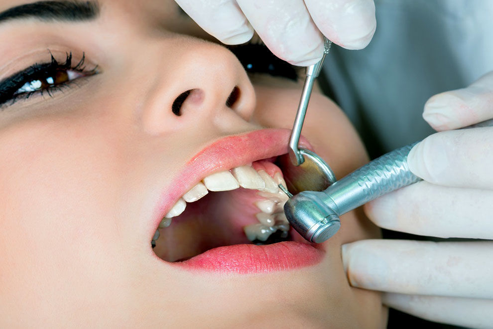 7 причин появления сколов на зубах, 5 видов и методы лечения